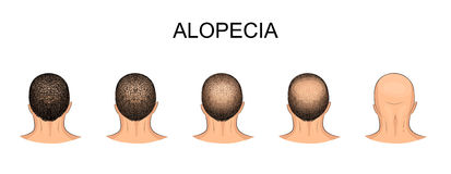 Baldness Stock Illustrations.