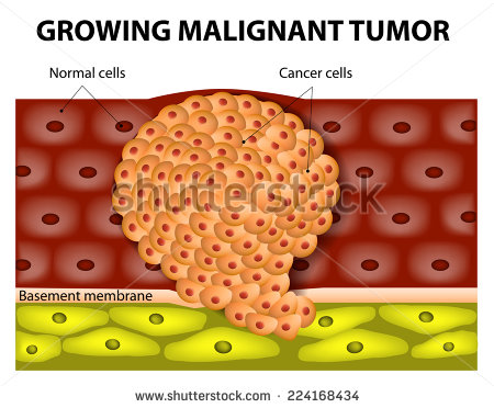 Malignant Clipart.