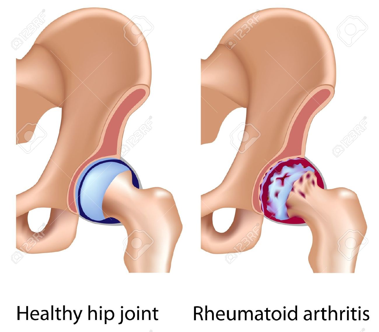 Rheumatoid Arthritis Of Hip Joint, Eps8 Royalty Free Cliparts.