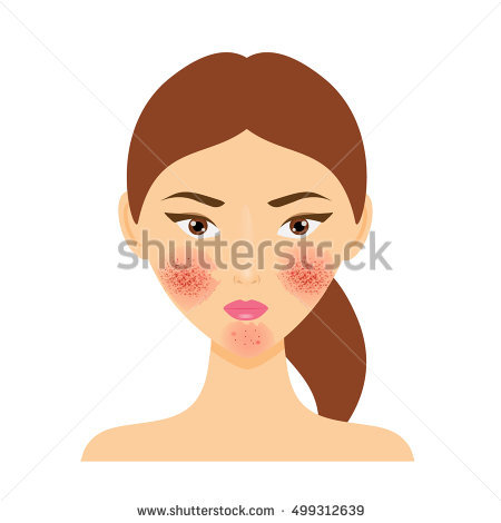 Rosacea Stock Vectors, Images & Vector Art.