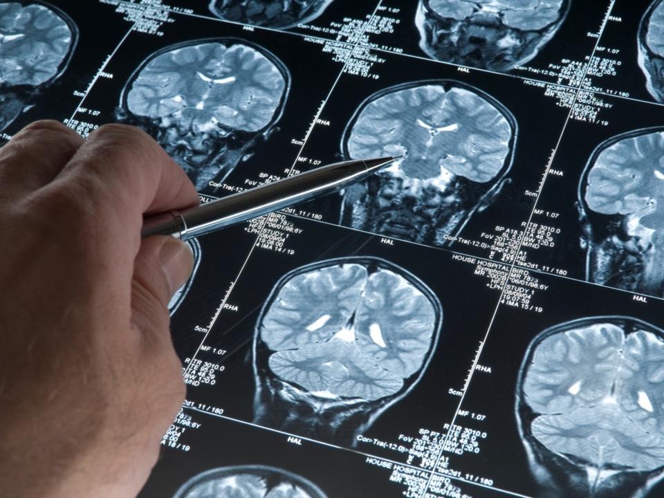 Alzheimer's vaccine beginning human trials