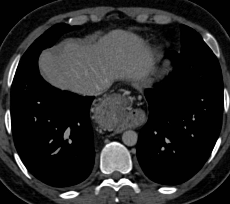 Paraesophageal Hiatal Hernia Esophagus Case Studies Ctisus Ct Scanning ...