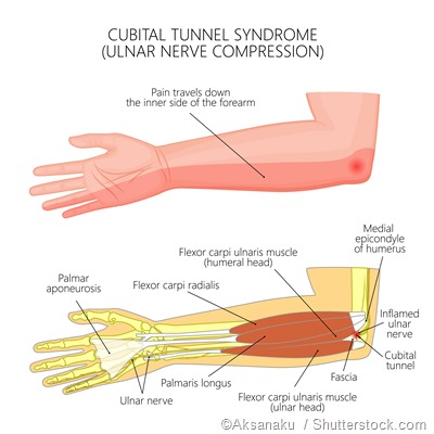 cubital tunnel syndrome