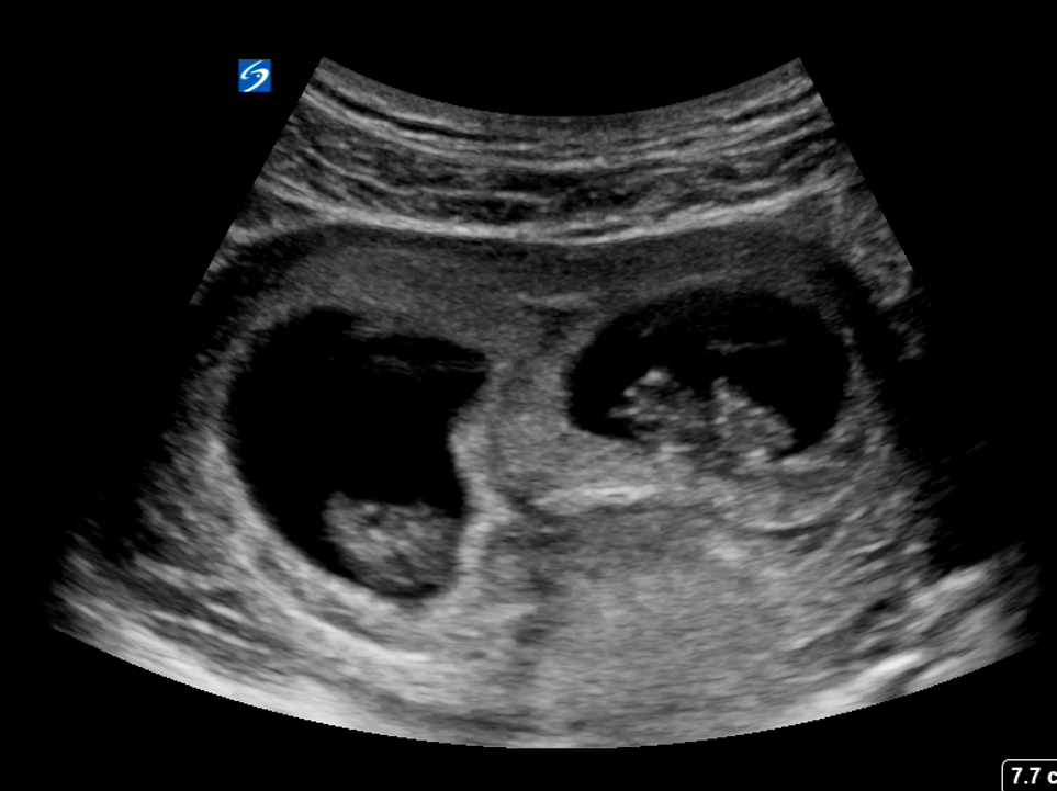 10 Weeks Pregnant Ultrasound Twins