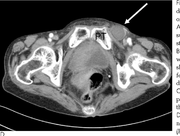 Inguinal Hernia Ct Scan