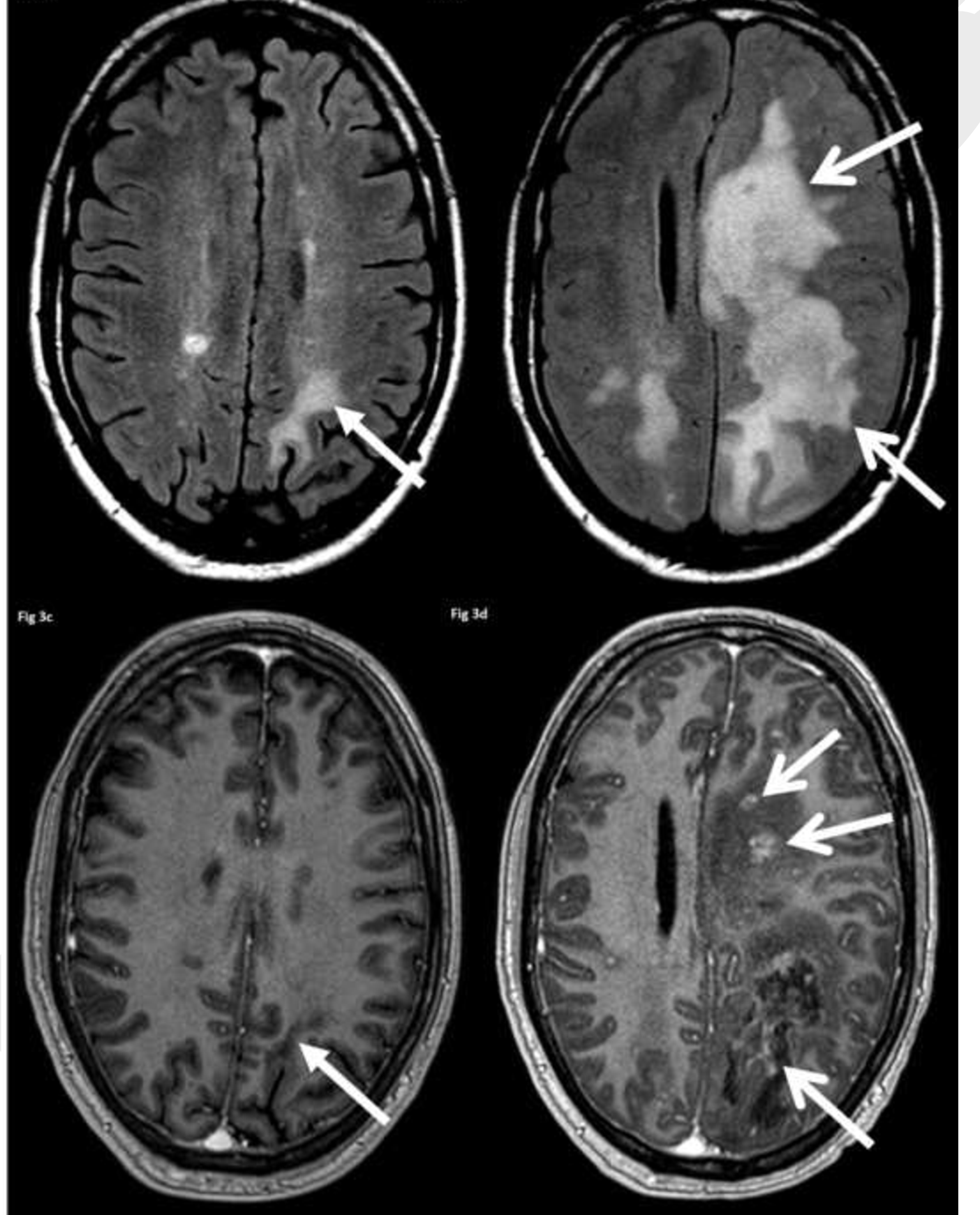 Ms Lesions Multiple Sclerosis Mri Brain Scan This Person Has Way | My ...