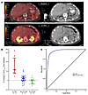 F18-FDG PET-CT and ICI-AKI.