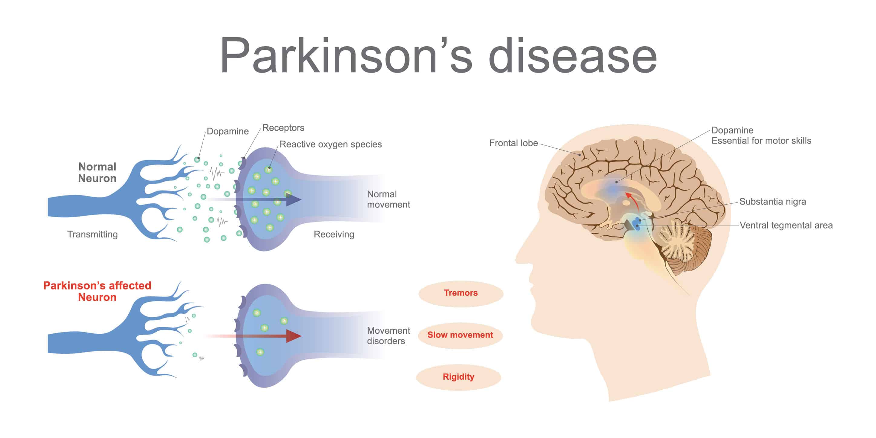 What Are The Best Essential Oils And Recipes To Manage Parkinson's ...