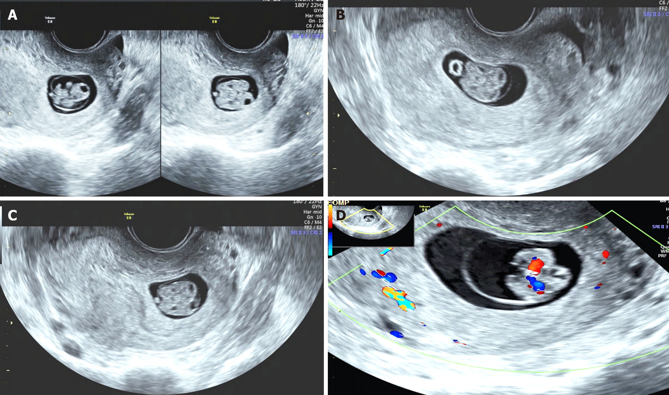 Identical Twins Ultrasound 7 Weeks