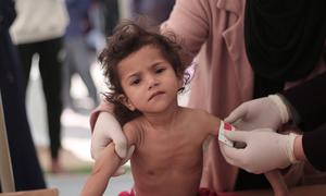 De nombreux enfants à Gaza présentent des signes de malnutrition aiguë sévère et une perte de poids drastique.