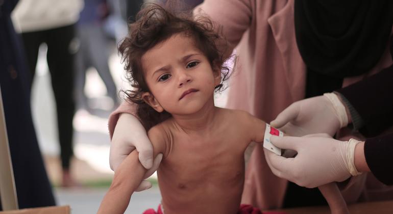 De nombreux enfants à Gaza présentent des signes de malnutrition aiguë sévère et une perte de poids drastique.