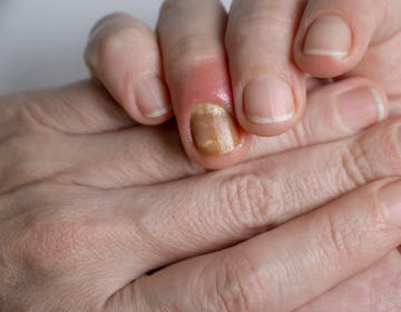 paronychia disease of the fingernail