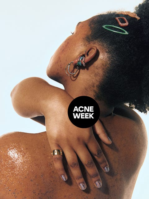 a closeup of a persons back with a focus on a hand accompanied by text overlay for acne week