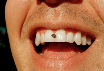 a mouth with food stuck in teeth