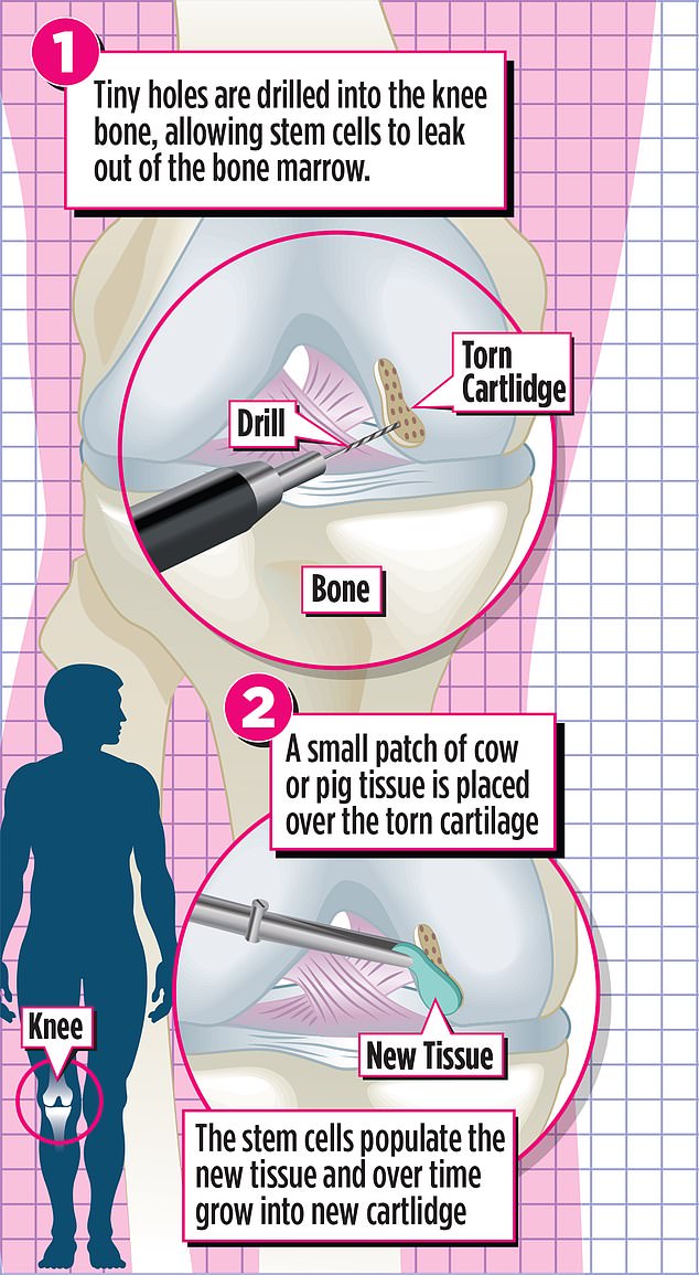 The major operation which involves cutting open the knee and replacing the joint with a metal or plastic implant. Knee replacements take about a year to recover from and sometimes the implant can become infected or wear down