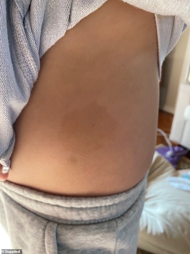 Tom's paediatrician noticed he had cafe au lait spots on his body. Cafe au lait marks are pigmented birthmarks which are harmless in the majority of cases but a common sign of NF1