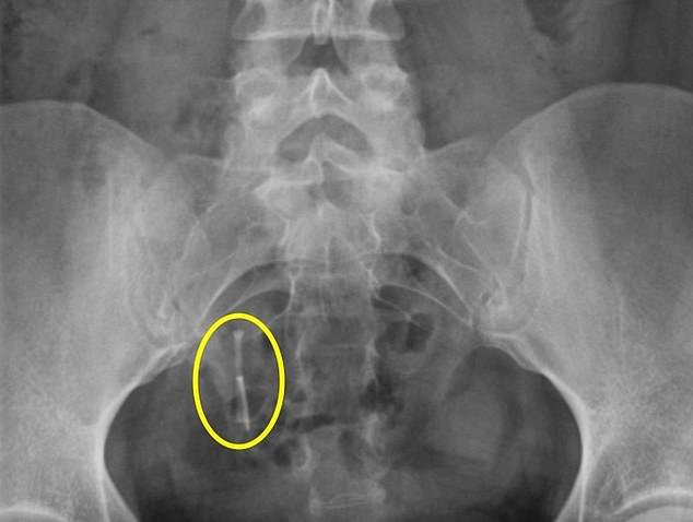 For nine years she couldn't understand why she couldn't conceive and it wasn't until she had an X-ray following a car accident in April 2021, that the IUD was spotted inside her colon, having perforated her uterus