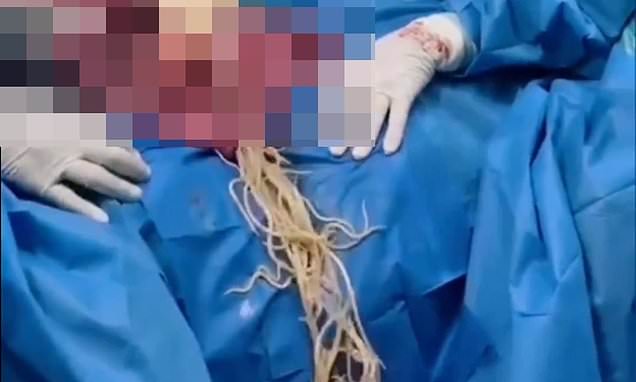 Chilling footage shows what happens when giant parasitic WORMS enter the gut - and