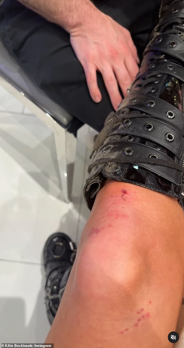 The British actress shared a clip to her Instagram of a pal tending to her bleeding leg