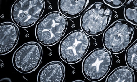 A CT scan of the head of a young woman who has multiple sclerosis – a series of black and white images showing her brain from different angles