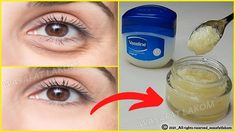 Home Remedy For Bags Under Eyes, What To Do For Under Eye Bags, Essential Oils For Puffy Under Eyes, Best Way To Get Rid Of Bags Under Eyes, What To Do For Puffy Under Eyes, Yea Bags For Eyes, Under Eyes Wrinkles Remedies, Vaseline For Under Eye Bags, What Helps With Eye Bags