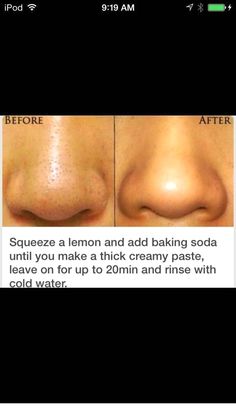 Obličejové Masky, Exposed Skin Care, Blackhead Mask, Diy Acne, Beauty Tips For Glowing Skin, Remove Acne