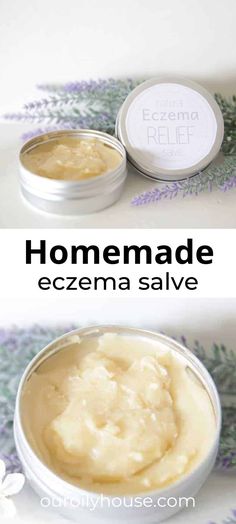 Coconut Oil For Excema, Homemade Excema Cream, Diy Excema Relief, Soap For Excema Sensitive Skin, Natural Remedy For Excema, What Helps Excema, How To Treat Excema, Natural Itch Relief Skin