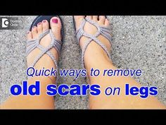 Scars  on the leg have become very common especially  when we have become younger  we tend  to have  lots of accidents, we tend to fall down,  bruises, cuts ... Leg Scars, Marks Cream, Under The Skin, Herbal Healing, Scar Removal, Hair Removal Cream, Diy Beauty Hacks, Diy Skin