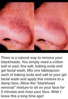 Blackhead Remedies, Blackhead Removal, Beauty Remedies, Homemade Beauty Products, Facial Wash