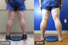 If you have vein problems, our gallery of varicose veins before and after pictures will help you see what sort of results you can expect with treatment from LLAV; see them here! Laser Lipo, After Pictures, Cosmetic Procedures, Muscle Aches, Abdominal Pain, Before And After Pictures, After Photos, Cosmetic Surgery, You Are Awesome