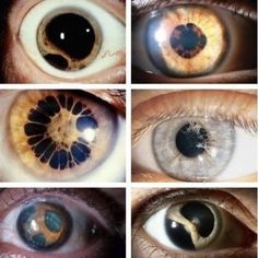 four pictures of different colored eyes with brown and blue irises, one showing an eyeball