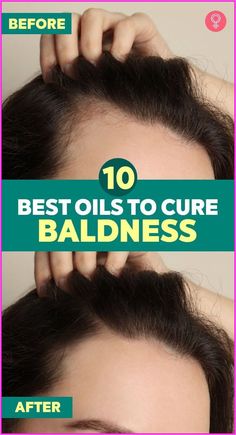 Bonus: Use a shower filter to remove chlorine and other chemicals from your water. #hairgrowthresults #hair #hairfall How To Grow Hair Back In Bald Spot, How To Get Rid Of Bald Spots For Women, Hair Growth For Bald Spots, How To Grow Hair In Bald Spots, Expensive Hair, Thinning Hairline, Hair 101, Aging Hair, Receding Hairline