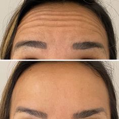 Armonizacion Facial, Botox Facial, Face Injections, Face Plastic Surgery, Cosmetic Web, Face Fillers, Hair Job, Cosmetic Injectables, Injectables Fillers