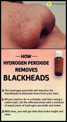 Get Rid Of Blackheads, Hydrogen Peroxide, Natural Home Remedies, Health And Beauty Tips, Skin Tips, Blackhead Remover, The Skin, Face Care