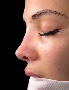 rhinoplasty nose job Good Nose Jobs, Persian Nose Job, Straight Upturned Nose, Nose Job Results, Ideal Nose Rhinoplasty, Nose Inspiration Rhinoplasty, Barbie Nose Rhinoplasty, Perfect Nose Rhinoplasty, Wide Nose Rhinoplasty