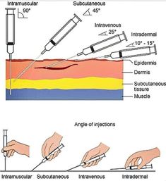 the diagram shows how to use an infrancular and subcuttanous needle