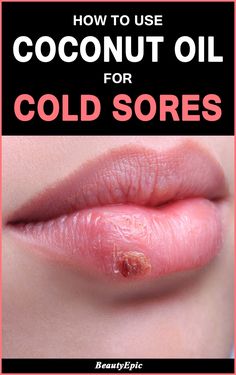 Cold Sore Scab, Cold Sore Remedy Fast, Cold Sore Remedy Overnight, Coconut Oil Remedies, Coconut Oil For Acne, Cold Sores, Home Remedy For Cough, Cold Sores Remedies