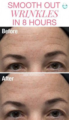 #SkinWartsOnElbow Brow Wrinkles, Beauty Hacks That Actually Work, Remove Warts