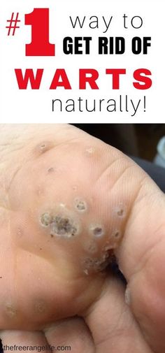 Warts can be painful and embarrassing to deal with. Ditch the over the counter chemicals and learn how to get rid of warts naturally! Natural Wart Remover, Get Rid Of Warts, Cold Home Remedies, Lose 40 Pounds, Natural Home Remedies, Natural Medicine, Health Remedies