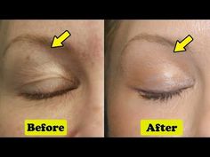 Drooping Eyelids, Droopy Eyelids, Droopy Eyes, Face Yoga Exercises, Face Yoga Facial Exercises, Erase Wrinkles, Facial Yoga, Eye Exercises, Face Exercises