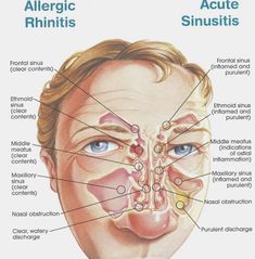 Sinus Medicine, Acute Sinusitis, Maxillary Sinus, Sinus Congestion Relief, Congestion Relief, Allergic Rhinitis, Sinus Congestion, Medical Anatomy, Sinus Infection