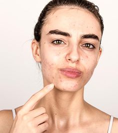 Changing #hormones_cause #acne, which is why so many young people get it during puberty or right before their periods. These hormones stimulate the glands in your pores to make more oil, which can clog your pores. Luckily there are some good #acnetreatments available today.Start With Over-the-Counter #Acne_Treatments.Do Daily #FacialCare: #Wechsler suggests this three-minute routine.#skincare  #healthyrecipes  #makeup #facecream #homemade #bodycare Acne Vulgaris, Natural Acne Remedies, Types Of Acne, Hormonal Acne, Cystic Acne, Acne Remedies, Skin Cleanser Products, How To Treat Acne, Skin Cells