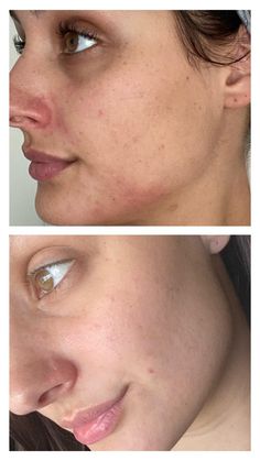 Clear Porcelain Skin, Procell Microchanneling Before And After, Glowing Clear Skin Aethstetic, Hooded Eyelids, Head Bandana, Instagram Frame Template, Beauty Companies, Skin Care Mask, Skin Care Solutions