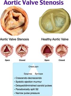 the stages of aortic valve stenosis and how they are used to treat them