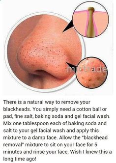 Black Heads, Remove Blackheads, Clear Skin Tips, Skin Care Solutions, Body Skin Care Routine, Diy Skin Care, Diy Skin, Healthy Skin Care, Beauty Skin Care Routine