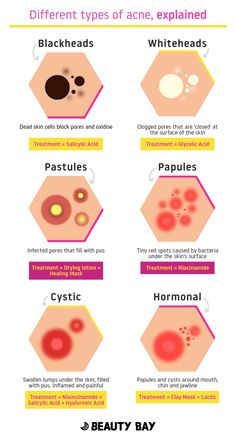 Skincare For Combination Skin, Different Types Of Acne, Types Of Acne, Image Skincare, Oily Skin Care, Skin Care Routine Steps, Beauty Bay