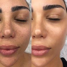 Plastic Surgery Fail, Plastic Surgery Gone Wrong, Face Surgery, Prime Skin, Nose Surgery, Skincare Inspiration, Skin Medica