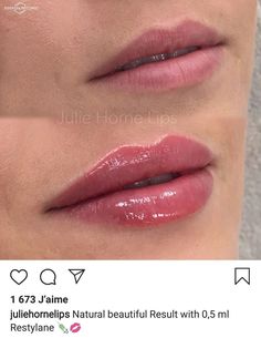 Lip Injections Heart Shape, Lip Filler One Syringe, Lip Filler On Small Mouth, Small Lips Lip Filler, Lip Injections Before And After 0.5ml, Lip Filler Before And After Small Lips, Restalyne Kysse Lips, Lip Filler Shape Ideas Natural, Lip Filler Inspo Natural