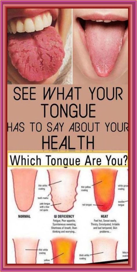 What Your Tongue is Trying to Tell You About Your Health #tongue Tongue Health, Tongue Cleaner, Feeling Hot, Dull Hair, Shortness Of Breath, Body Organs, Nail Health, Medical Problems, Digestive System