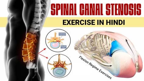 Lumbar Canal Stenosis Exercises, Spinal Canal Stenosis, Stenosis Exercises, Spine Pain, Psoas Muscle, Nerve Pain Relief, Sciatic Nerve Pain, Sciatic Nerve, Nerve Pain